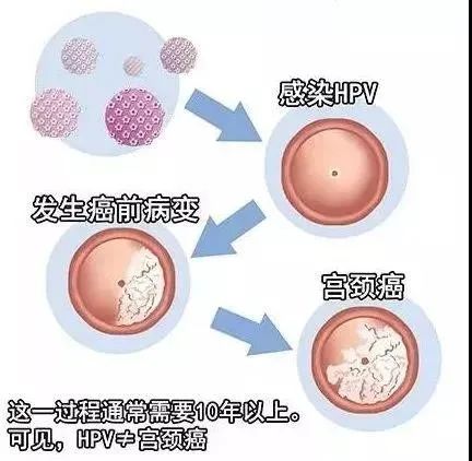 hpv感染很常见,多数hpv感染无症状,但是感染hpv不能直接与宫颈癌划