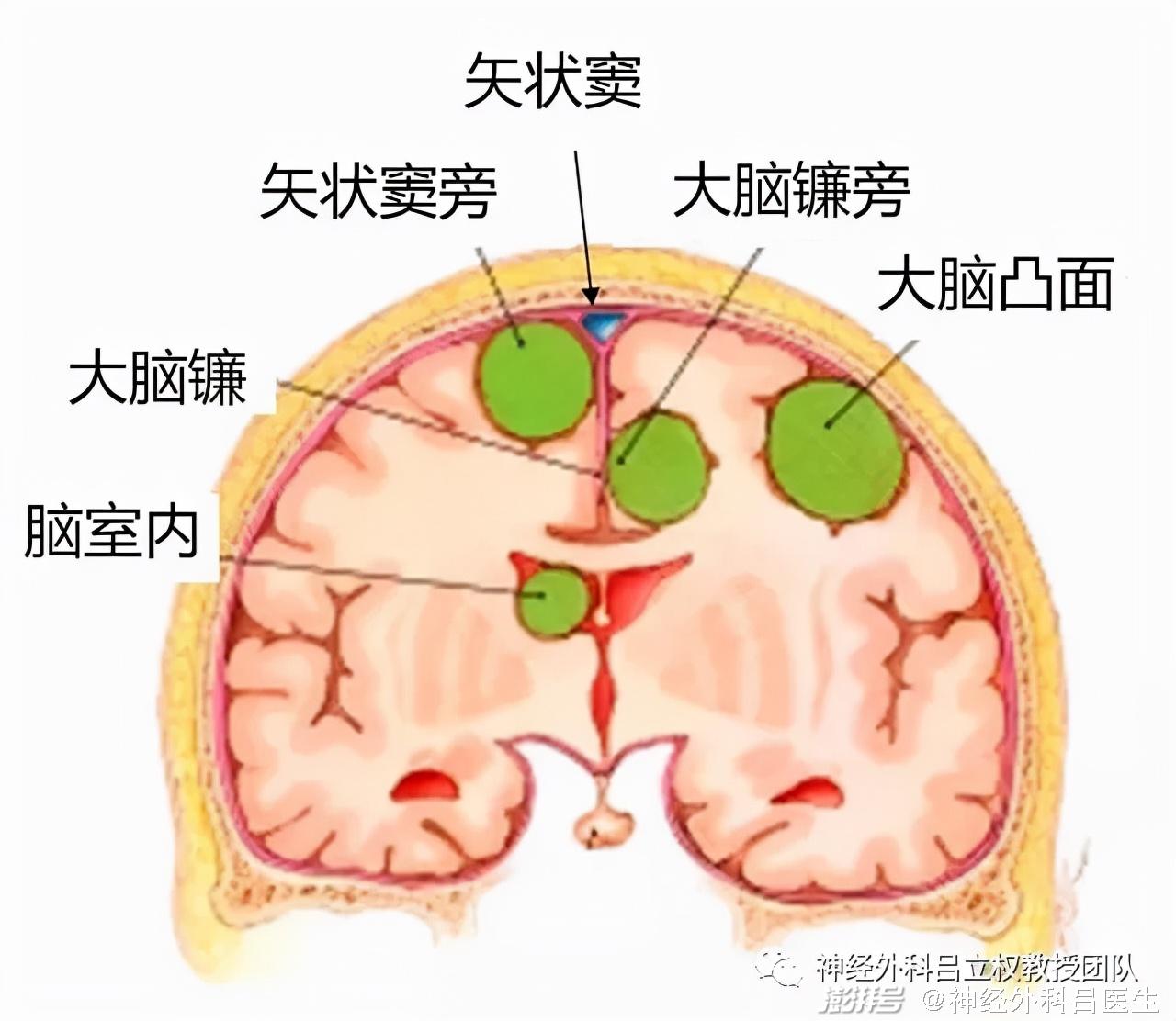 脑膜瘤位置图解图片