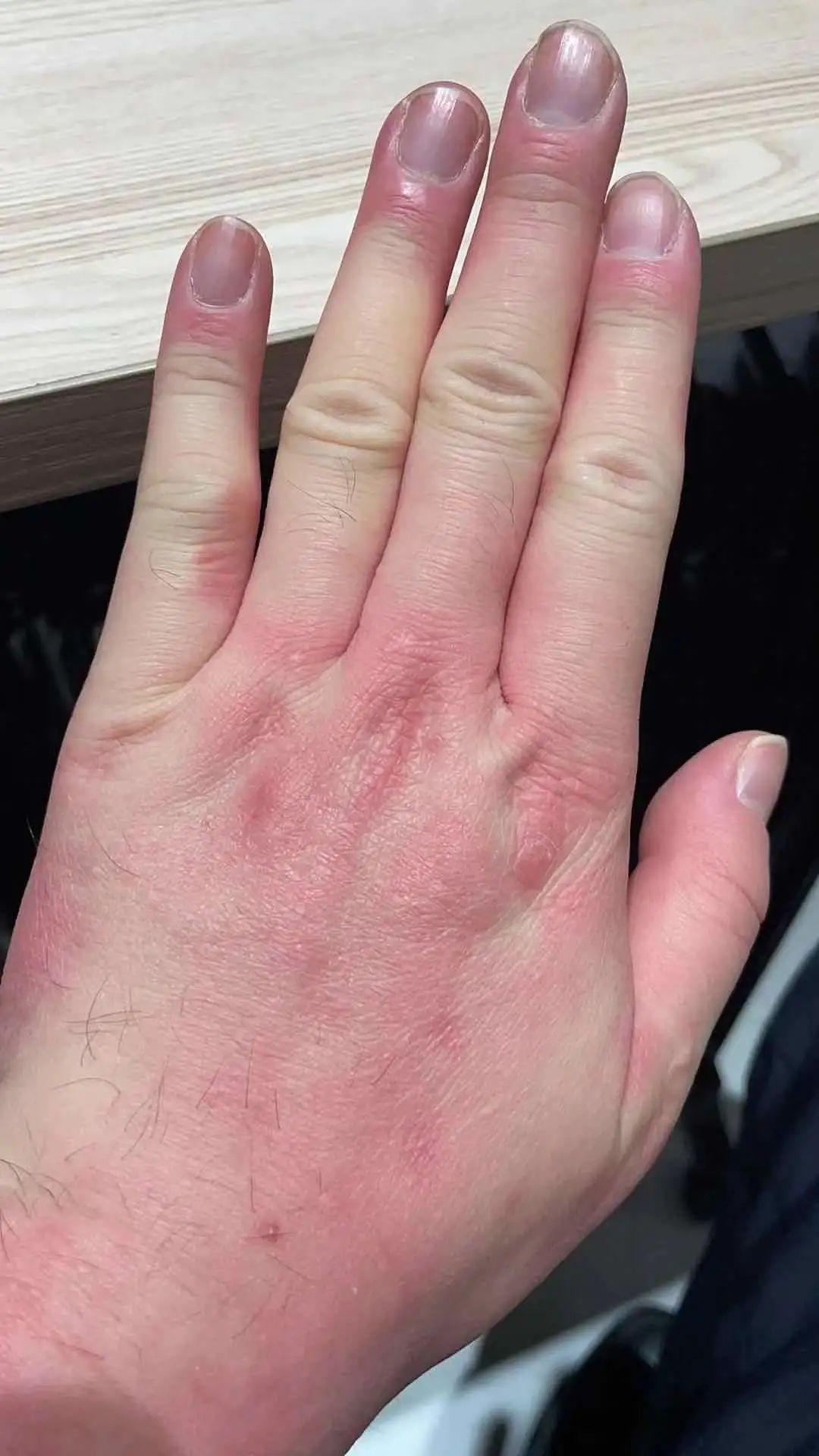 手冻伤的症状图片