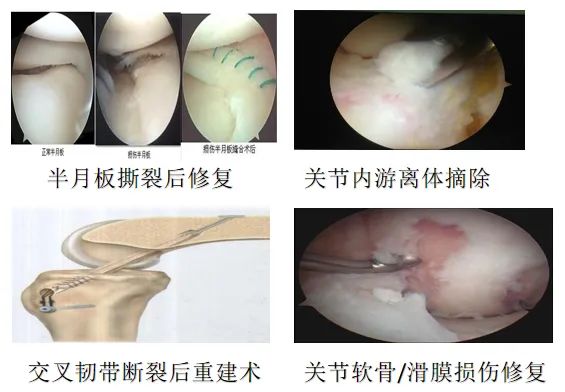 四肢关节类风湿性关节炎滑膜切除,关节灌洗清创术,膝关节撕裂半月板