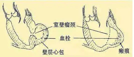 门诊日记2心梗后室壁瘤的治疗