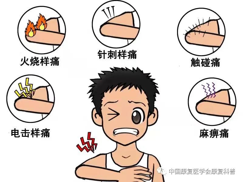 损伤或神经系统问题引起的疼痛,通常表现为烧灼感,麻刺感,锐痛或刺痛
