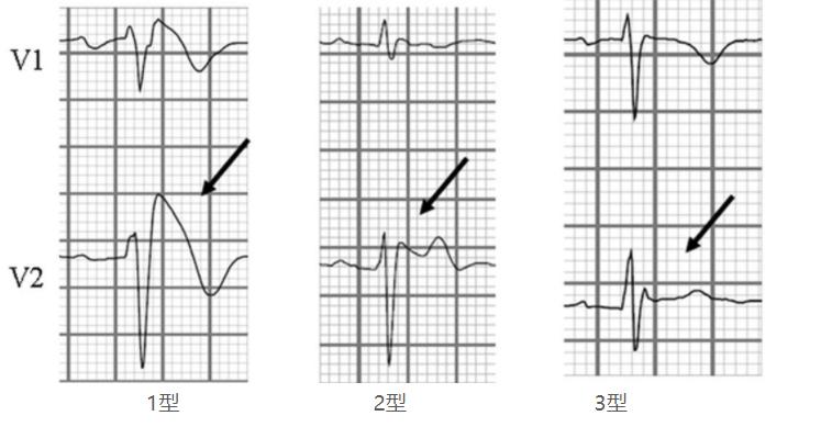 類右束支傳導阻滯,右胸導聯(v1-v3)st段呈穹窿樣或馬鞍形抬高,t波倒置