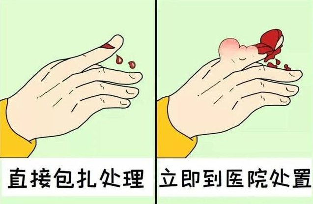 儿童手外伤频发,该怎么正确处理呢?