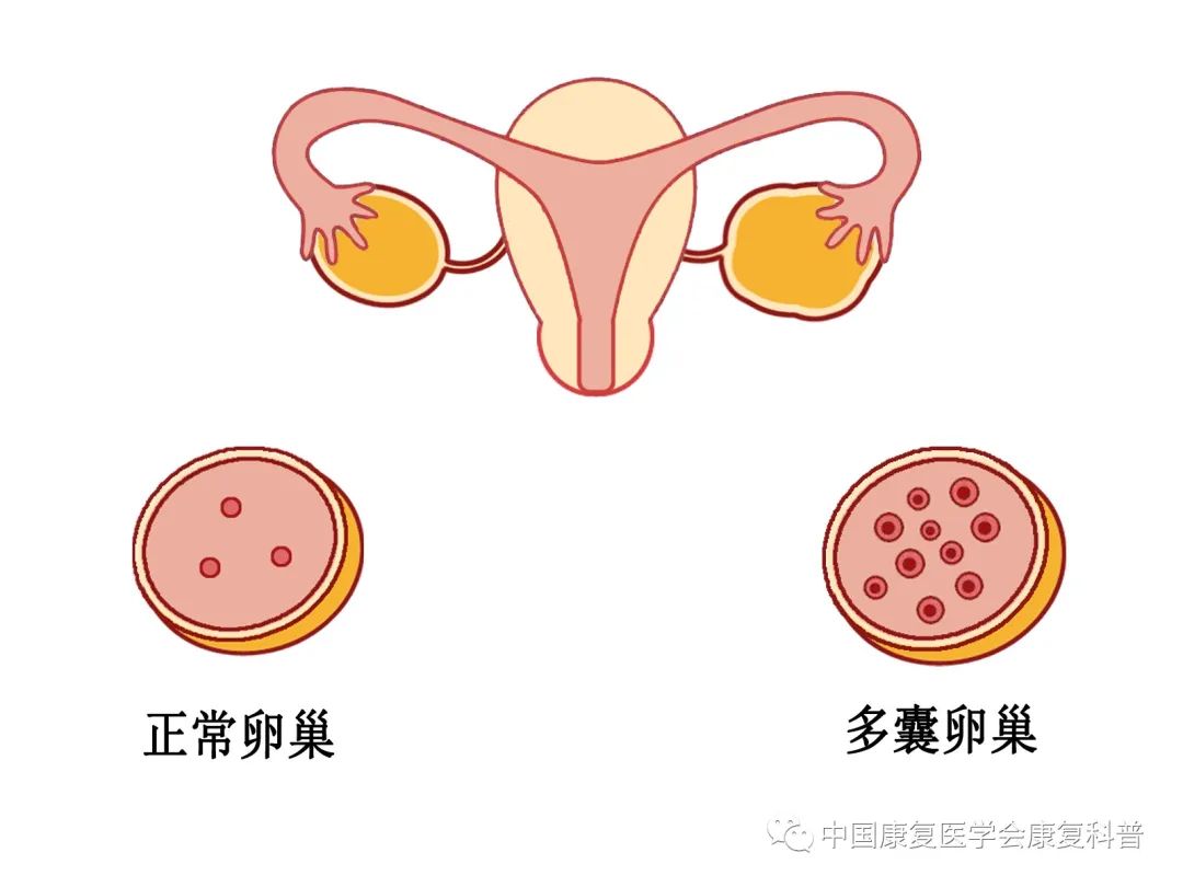 问怎样的人算是多囊卵巢综合征?
