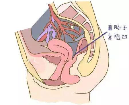 每个女人都有盆腔积液只有这些情况需要治疗