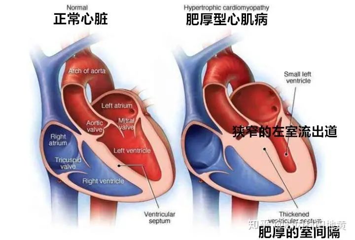 门诊日记4肥厚性心肌病导致的心力衰竭