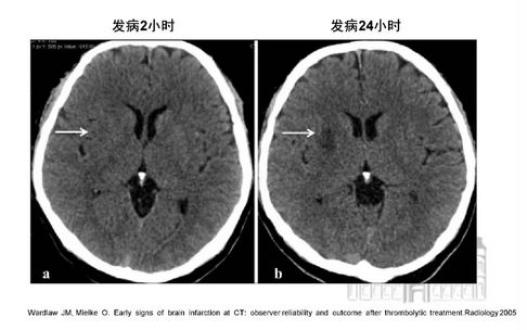 脑梗塞片子图片图片