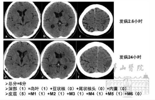 ncct早期缺血徵象,梗死核心與半暗帶 ↓dwi可以早期識別急性缺血灶