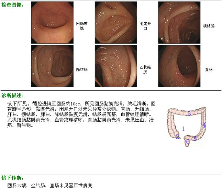 图2肠镜检查结果科内给予讨论,最终确定病情!