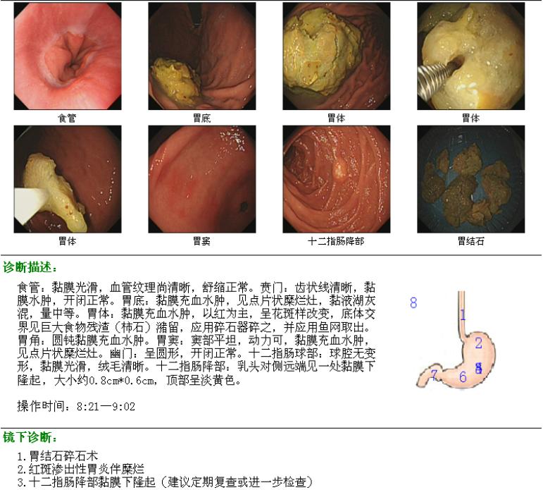 無誘因腹痛胃鏡示胃結石這個病因不能忽視