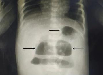 患儿出生反复呕吐,腹胀,无胎粪排出,诊断为这种消化道畸形疾病