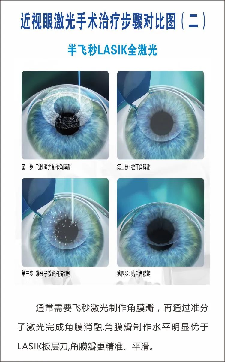 全飞秒激光近视矫正手术寒假特惠福利已送达北流市人民院眼科很多小