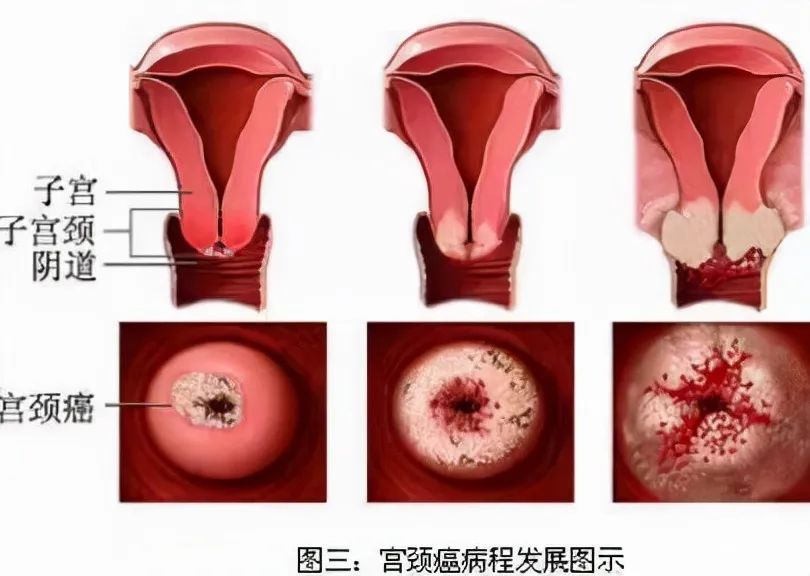 宫颈纳囊的图片图库图片