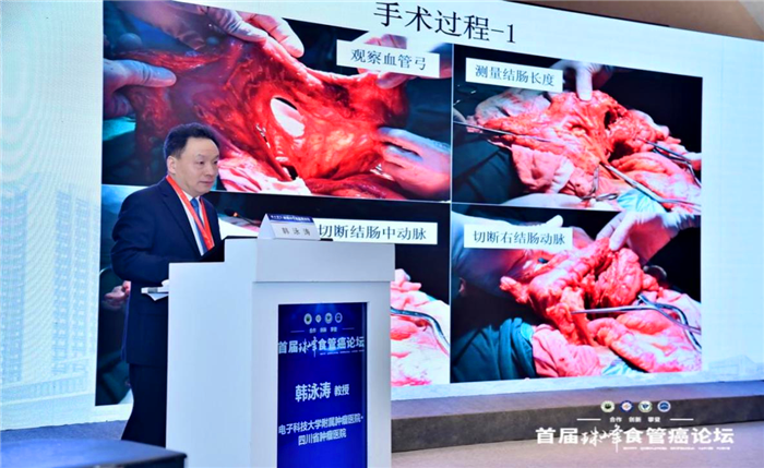 中国医学科学院肿瘤医院毛友生教授整个会议围绕食管癌热点,难点问题
