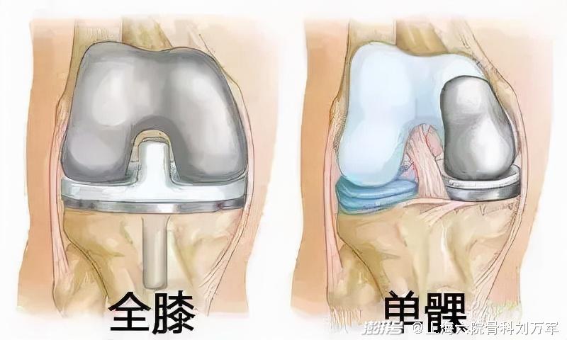 膝關節置換單點還是套餐