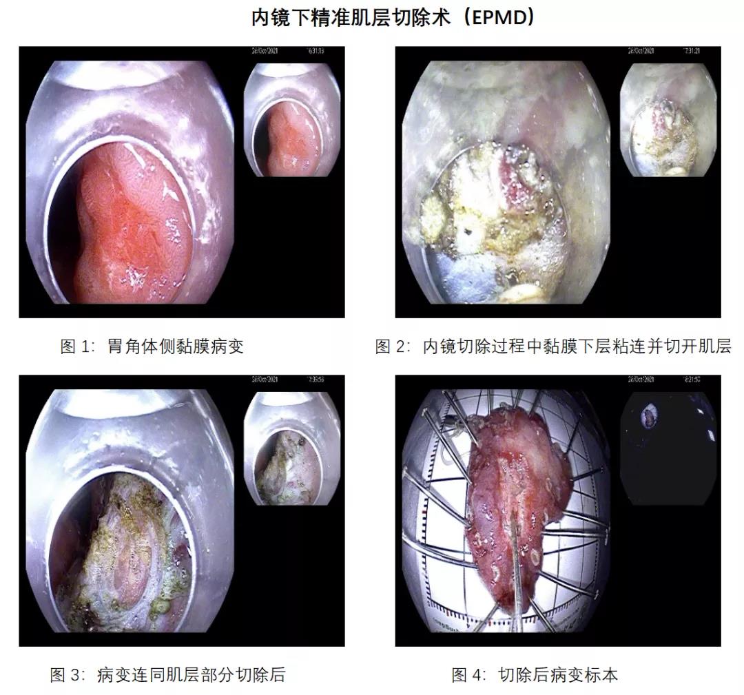 行內鏡切除過程中發現病變黏膜下層粘連嚴重,但外科手術創傷大,與患者