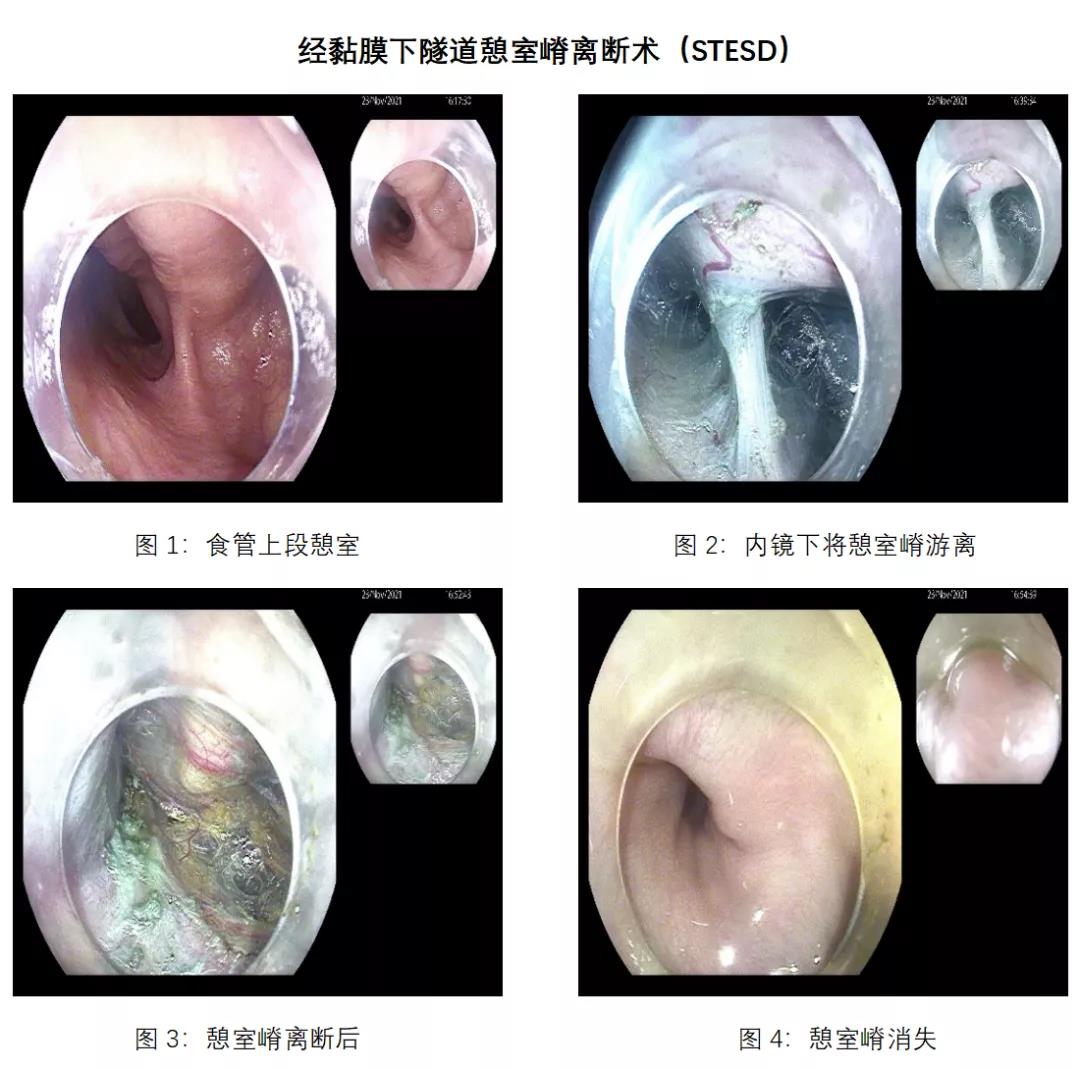 直肠癌吻合口瘘图片图片