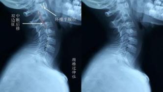 門診來了個“落枕”的孩子，檢查結(jié)果竟是頸椎脫位了？