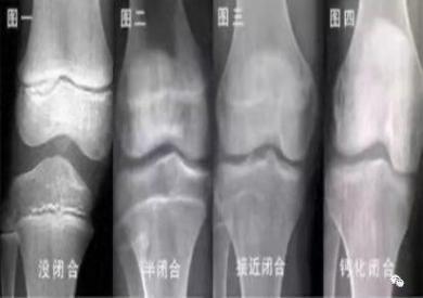儿童膝关节骨骺图片图片
