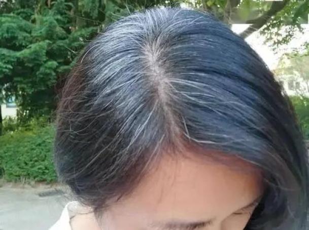 为什么压力大时会长白头发?这些习惯可能会让你早生华发