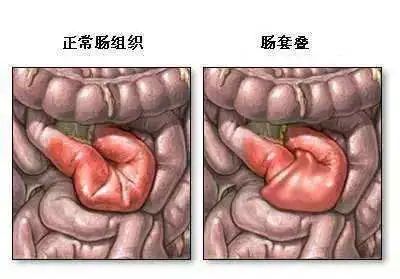 腹部ct平扫提示右下腹结肠占位伴肠套叠可能.