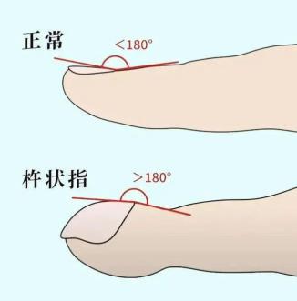 正常人的角度小於160°,但早期杵狀指甲上角往往大於180