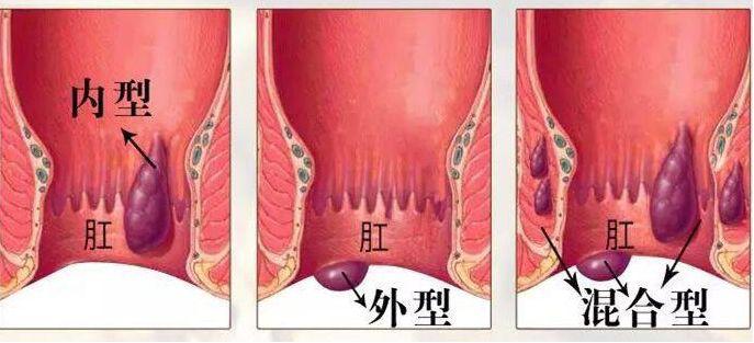 什么是软式内镜镜【浦人医·健康】健康知识月月讲之有”痔”者，是“镜”成！——痔疮的内镜治疗_https://www.jmylbn.com_新闻资讯_第2张