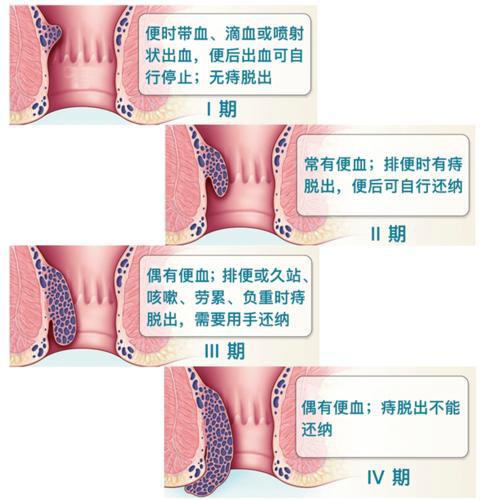 什么是软式内镜镜【浦人医·健康】健康知识月月讲之有”痔”者，是“镜”成！——痔疮的内镜治疗_https://www.jmylbn.com_新闻资讯_第5张