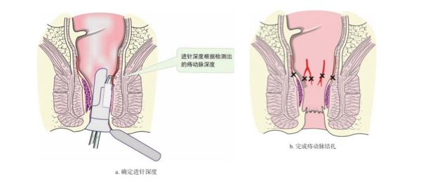 什么是软式内镜镜【浦人医·健康】健康知识月月讲之有”痔”者，是“镜”成！——痔疮的内镜治疗_https://www.jmylbn.com_新闻资讯_第8张