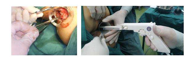 什么是软式内镜镜【浦人医·健康】健康知识月月讲之有”痔”者，是“镜”成！——痔疮的内镜治疗_https://www.jmylbn.com_新闻资讯_第9张