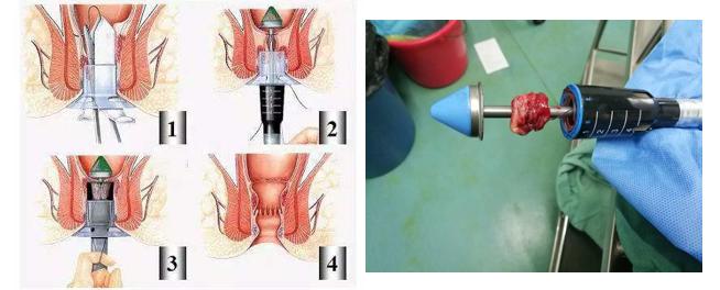 什么是软式内镜镜【浦人医·健康】健康知识月月讲之有”痔”者，是“镜”成！——痔疮的内镜治疗_https://www.jmylbn.com_新闻资讯_第10张