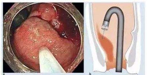 什么是软式内镜镜【浦人医·健康】健康知识月月讲之有”痔”者，是“镜”成！——痔疮的内镜治疗_https://www.jmylbn.com_新闻资讯_第11张