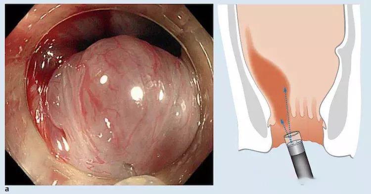 什么是软式内镜镜【浦人医·健康】健康知识月月讲之有”痔”者，是“镜”成！——痔疮的内镜治疗_https://www.jmylbn.com_新闻资讯_第12张
