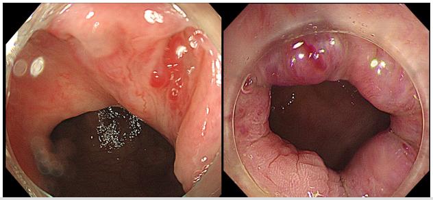 什么是软式内镜镜【浦人医·健康】健康知识月月讲之有”痔”者，是“镜”成！——痔疮的内镜治疗_https://www.jmylbn.com_新闻资讯_第13张