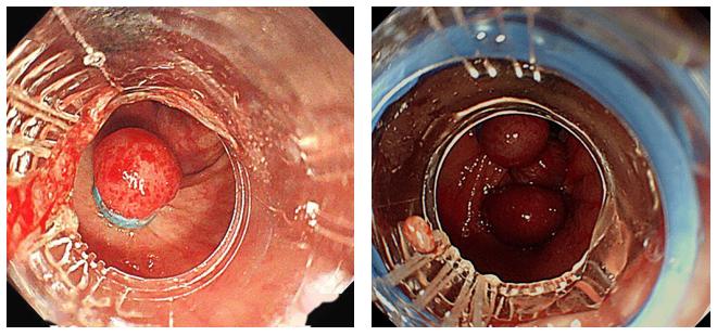 什么是软式内镜镜【浦人医·健康】健康知识月月讲之有”痔”者，是“镜”成！——痔疮的内镜治疗_https://www.jmylbn.com_新闻资讯_第14张