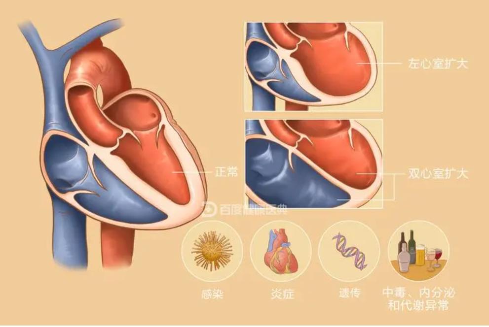门诊日记6扩张型心肌病持续治疗的重要性