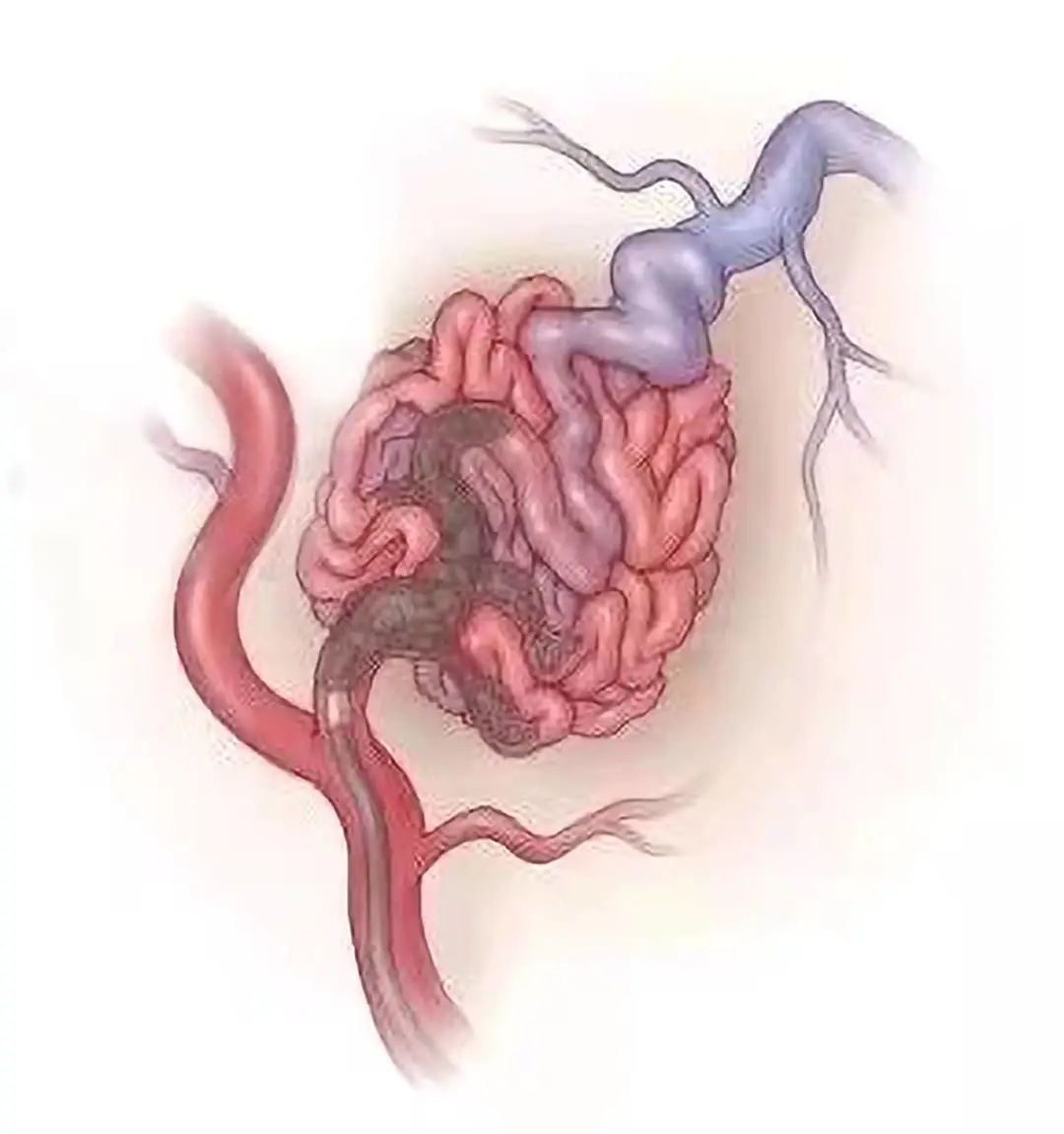 腹腔血管畸形图片