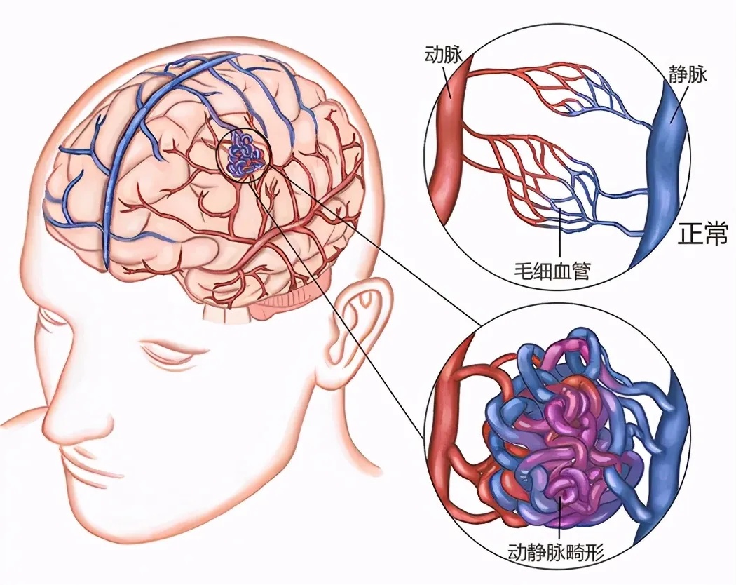 一旦腦動脈與靜脈