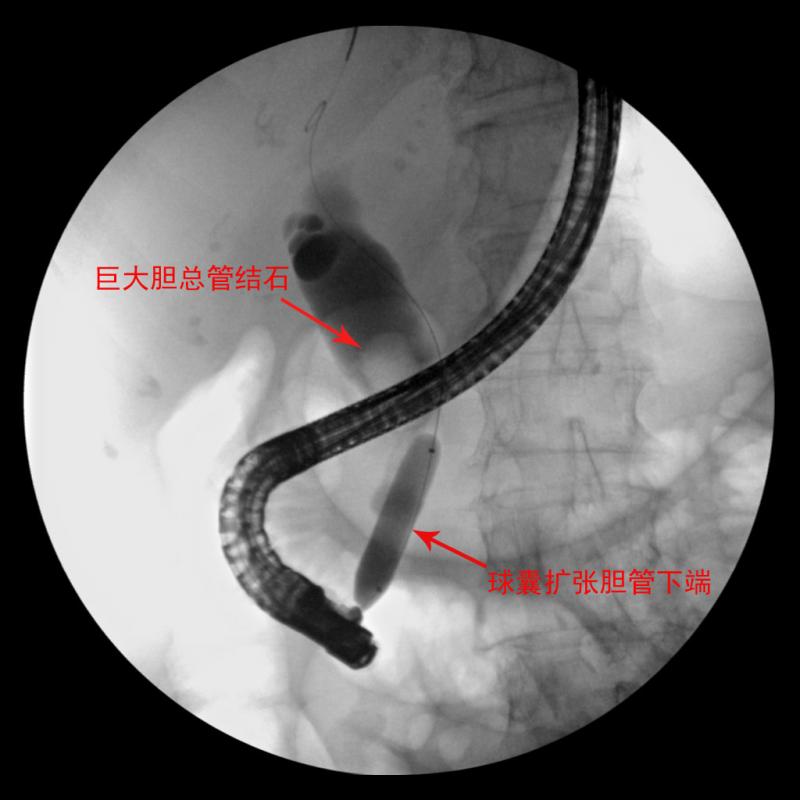 内镜下胆总管球囊扩张术内镜下碎石网篮碎石取石网篮取净结石碎片