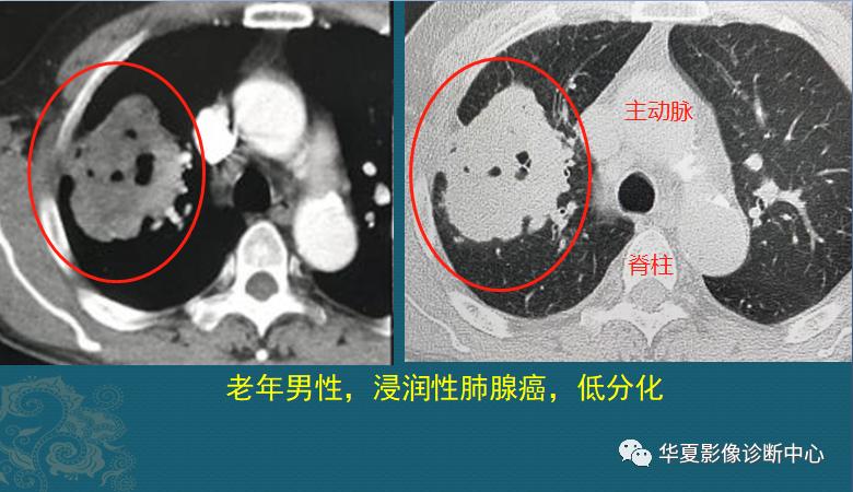 先問大家一個問題:從磨玻璃結節,到7cm的晚期肺癌,需要長几年?