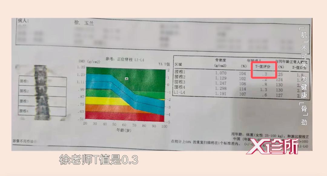 骨密度檢查報告的數值主要看