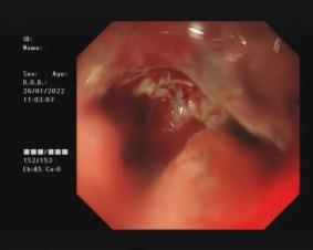 以為是慢性咽炎卻查出食道癌醫生兩者差距大別再混淆了