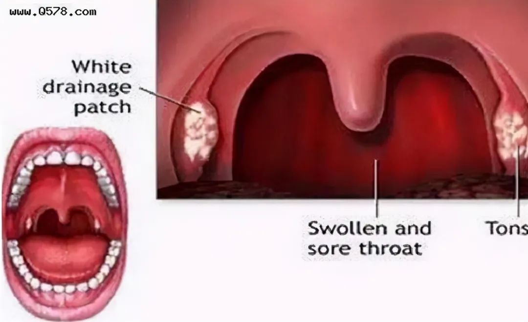 慢性咽喉炎喉癌图片