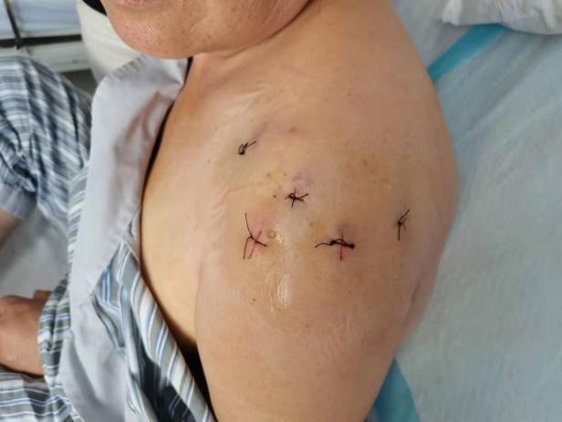 肩袖撕裂手术铆钉分类图片