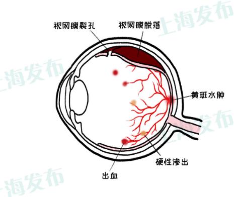 医聊血管生病会影响眼睛眼底煤气灶不能堵塞