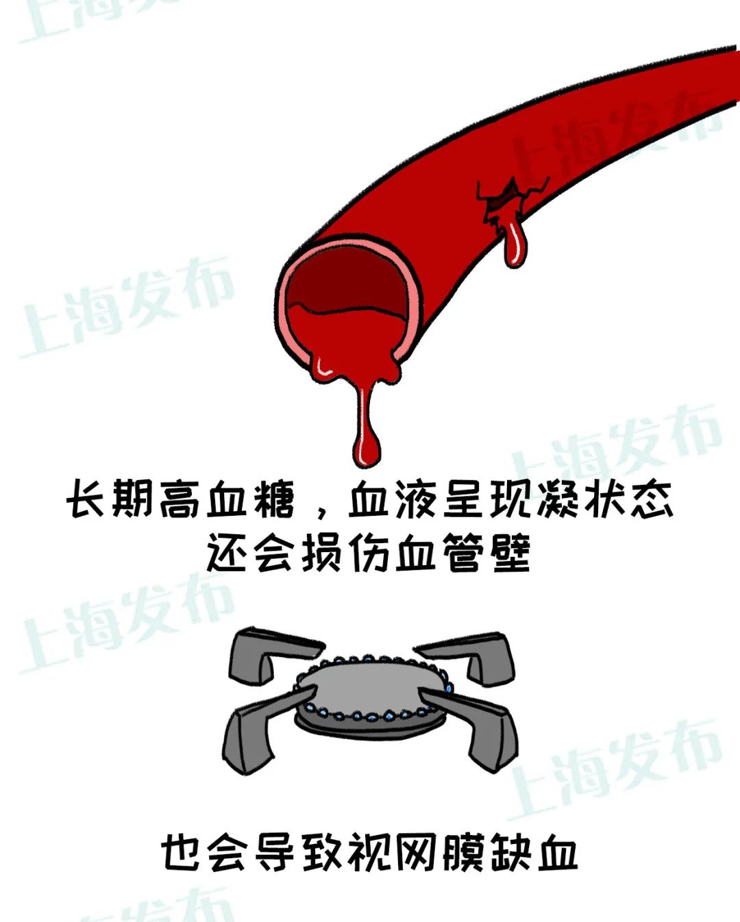 视网膜毛细血管壁损伤,血液呈现高凝状态,糖尿病患者长期高血糖会导致