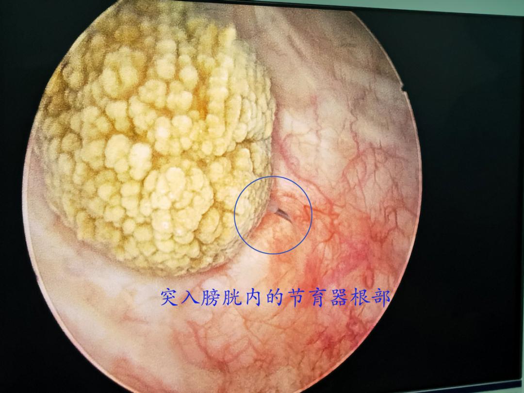 又見節育環穿透子宮刺入膀胱有這幾個症狀沒絕經也要去取環