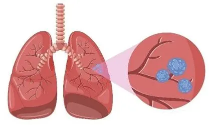 肺結節的病理學定義是:肺內不大於3釐米的類圓形或者形狀不規則的病灶