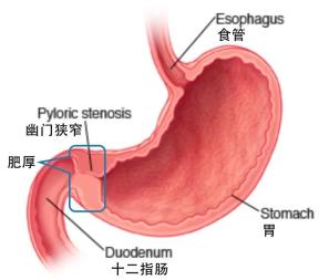 婴儿肥厚性幽门狭窄